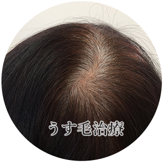 うす毛治療