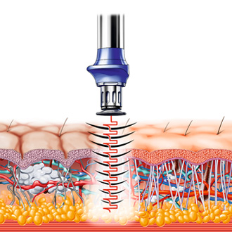 セルライトを除去