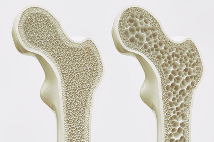 骨粗しょう症