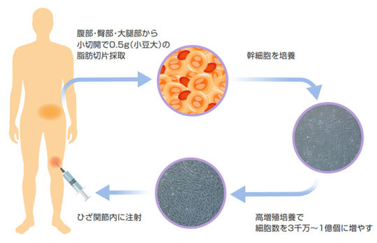 脂肪由来幹細胞(ASC)治療